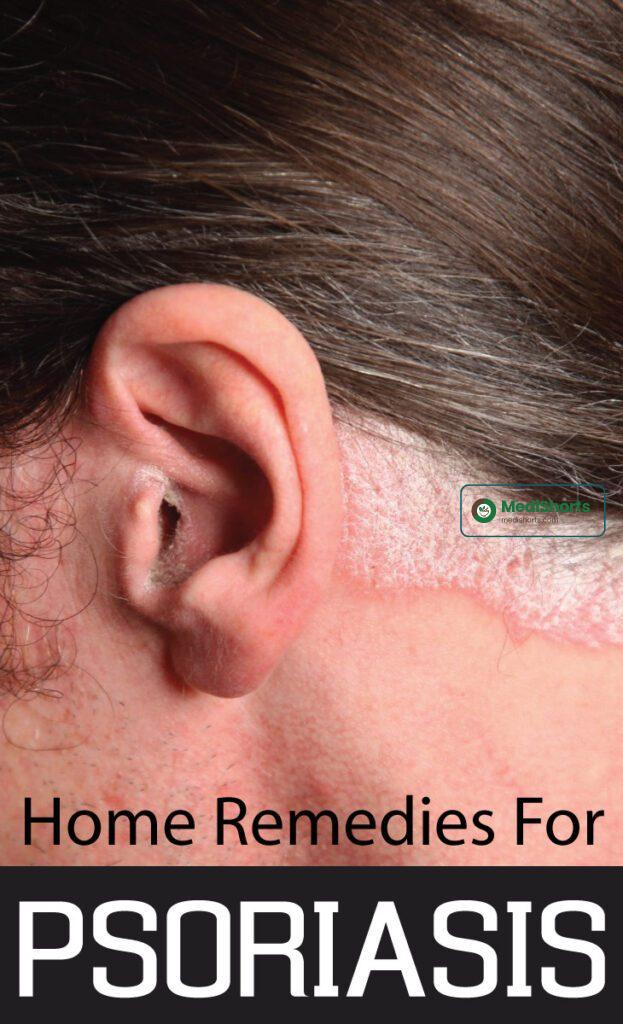 Remedies For Psoriasis