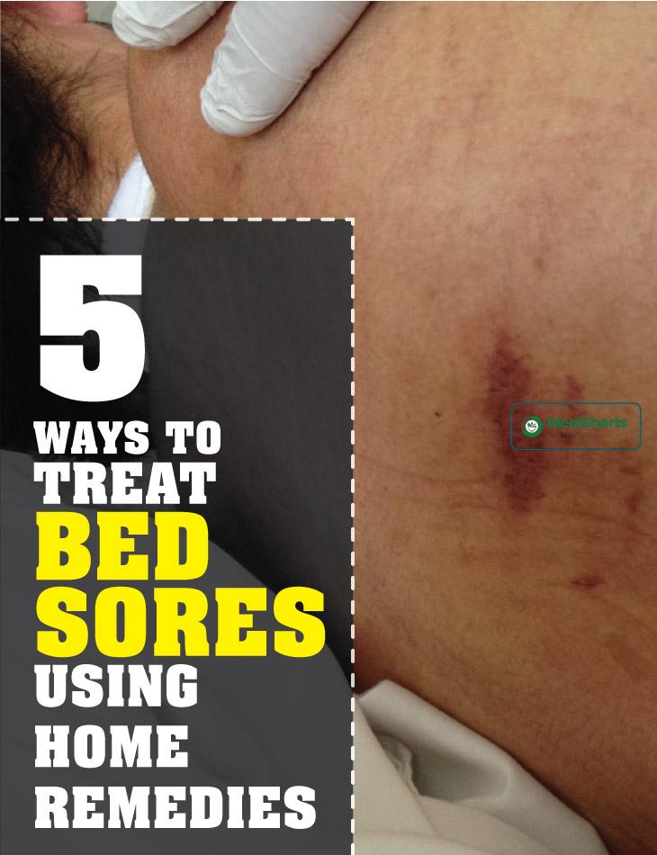 5 Ways To Treat Bed Sores Using Home Remedies