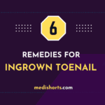 6 Home Remedies for Ingrown Toenail