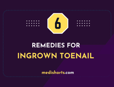 6 Home Remedies for Ingrown Toenail