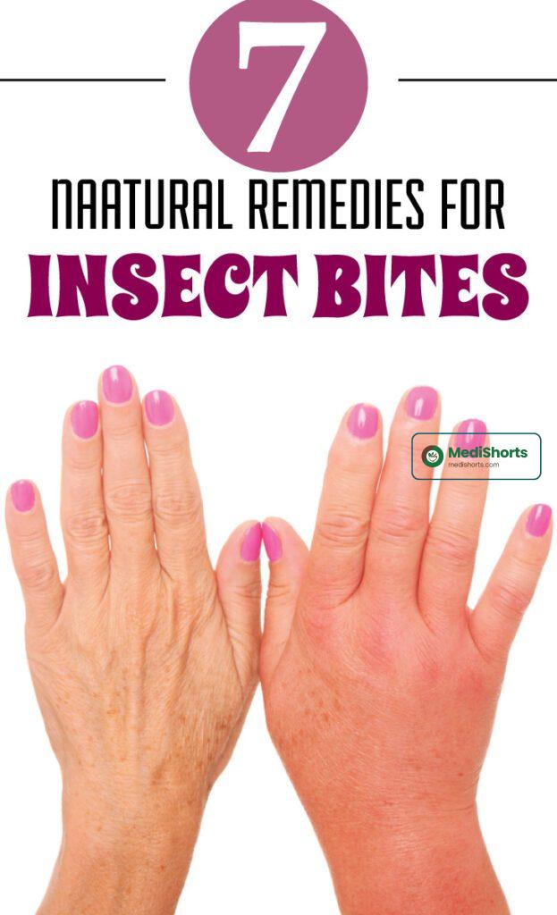 Insect Bites remedies