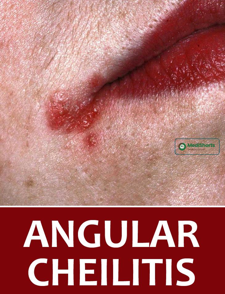 Angular Cheilitis 3