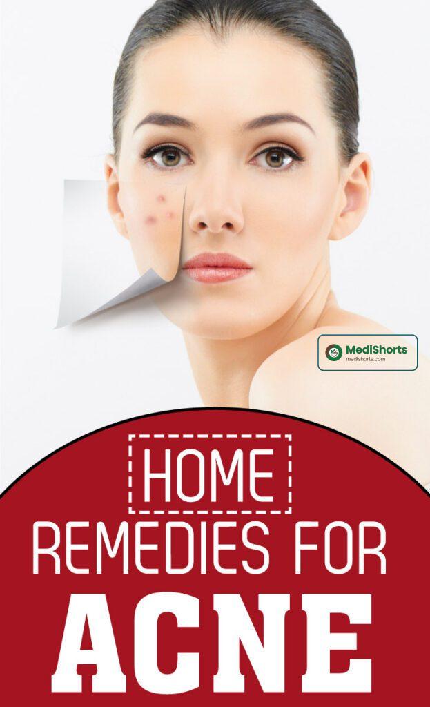 REMEDIES 
for ACNE
