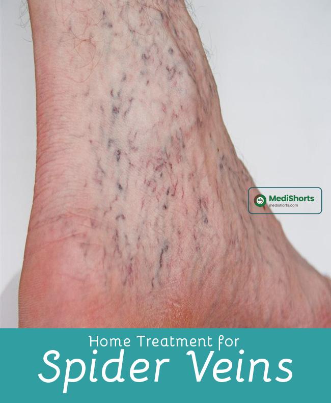 Home Treatment For Spider Veins 2