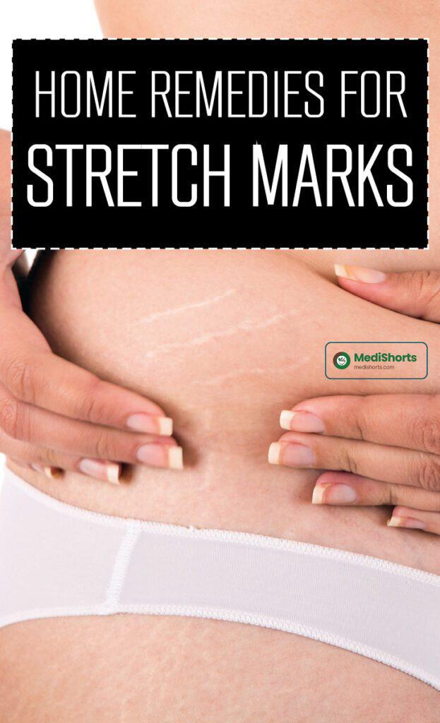REMEDIES for 
stretch marks