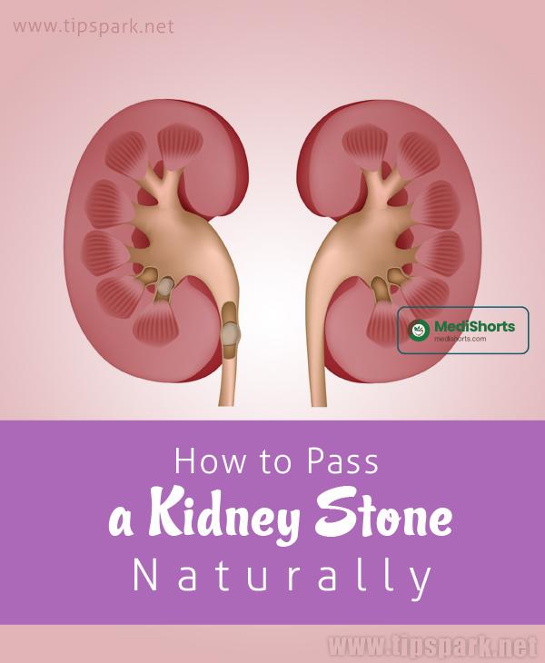 Kidney Stones Remedies