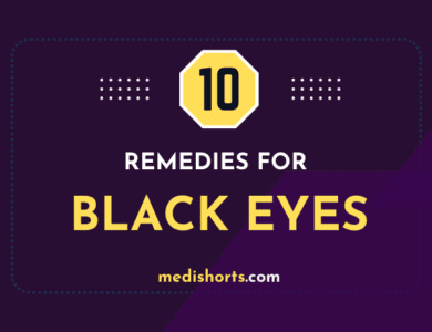 REMEDIES for black eyes