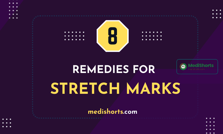 REMEDIES for stretch marks