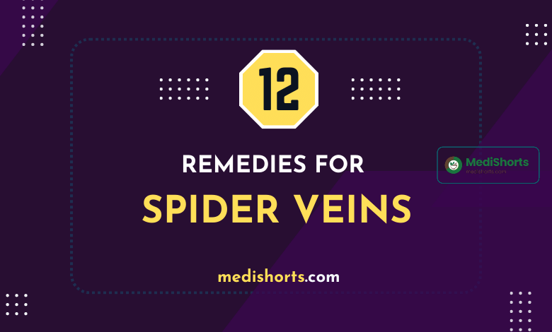 Spider Veins Natural Remedies